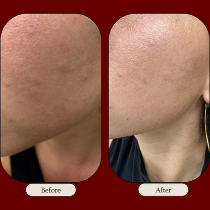 Before and after comparison of skin texture on a person's neck.